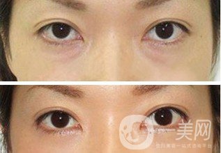 激光去眼袋手術(shù)后如何護(hù)理 要注意些什么