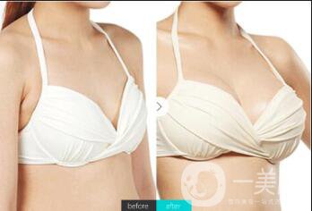 自體脂肪豐胸有些什么危害