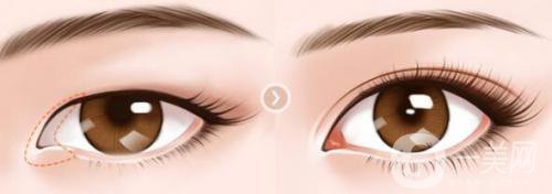 開眼角會疤痕增生嗎 術(shù)后應(yīng)該怎么護理