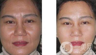 廈門做電波拉皮除皺多少錢