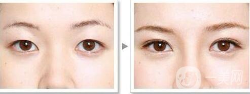 北京割雙眼皮的價(jià)格是多少錢