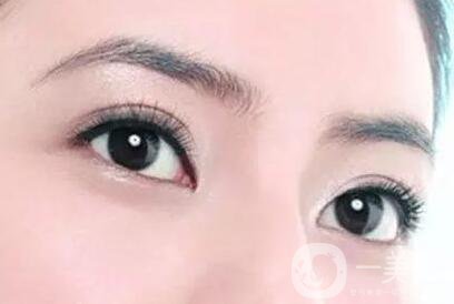 割雙眼皮痕跡多久消失？