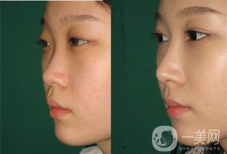 硅膠假體隆鼻為什么會發(fā)生感染