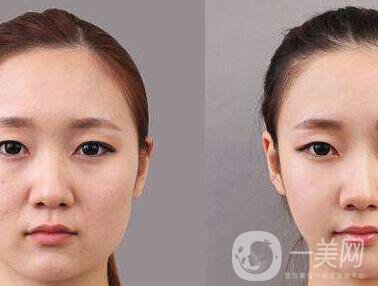 顴骨手術(shù)多長(zhǎng)時(shí)間恢復(fù)？