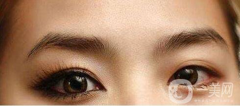 開眼角,開眼角手術過程,上海開眼角手術過程