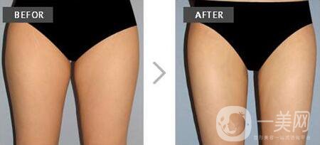 光纖溶脂,光纖溶脂多少錢,北京光纖溶脂多少錢