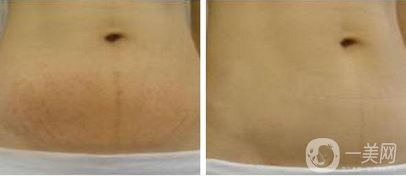 激光去妊娠紋,激光去妊娠紋費用,深圳激光去妊娠紋費用