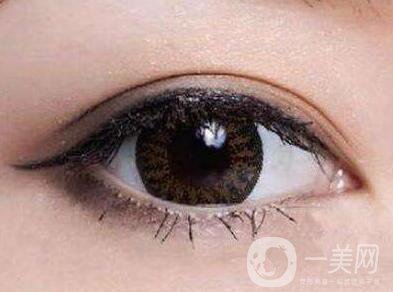 上海開(kāi)眼角手術(shù)的費(fèi)用是多少？