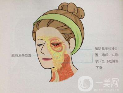 電波拉皮除皺*果好嗎？