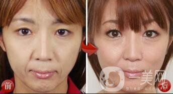 南京做電波拉皮手術(shù)價(jià)錢多少