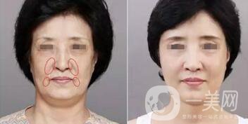 深圳埋線臉部提升價格多少