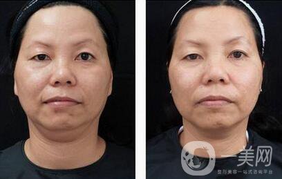 北京做冰電波拉皮除皺手術(shù)價格要多少錢