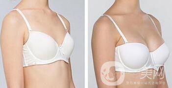 假體豐胸術(shù)后注意事項(xiàng)詳細(xì)介紹