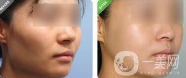 蘇州做顴骨手術(shù)多少錢