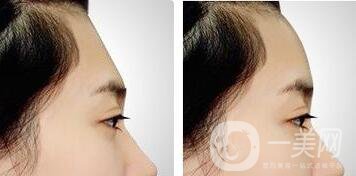 上海玻尿酸豐額頭的價(jià)格詳解