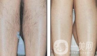 北京激光脫毛的價(jià)格到底是多少