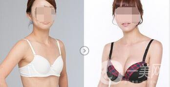 正規(guī)醫(yī)院做假體豐胸多少錢(qián)