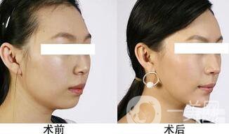 怎樣去掉雙下巴的方法介紹