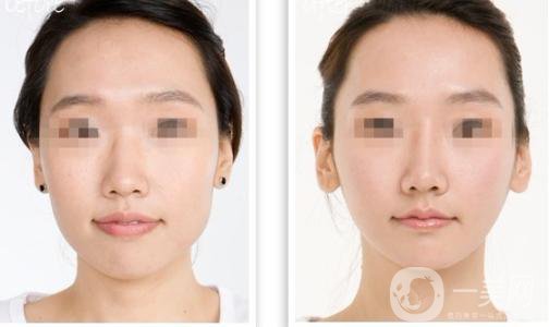 360溶脂減肥有什么副作用