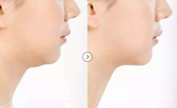 減雙下巴,減雙下巴方法