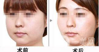 光纖溶脂瘦臉*果保持多久