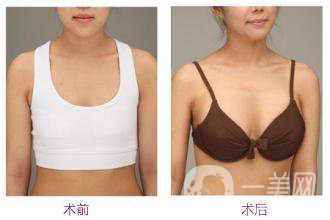 假體豐胸的*果能捏的出來嗎