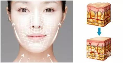 超聲波美容拉皮手術(shù)的價(jià)格一般是多少錢左右