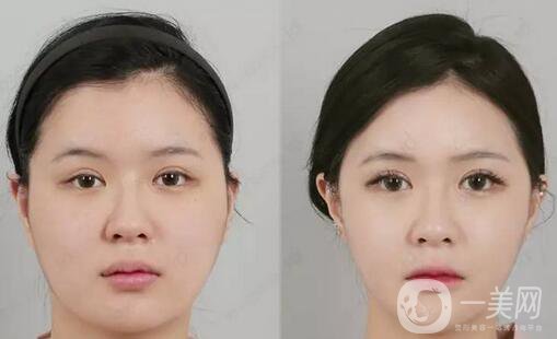面部拉皮哪種方法更好？