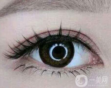 割雙眼皮怎樣可以快速消腫？