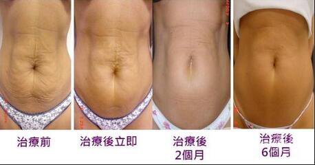 北京腹部切除拉皮手術(shù)多少錢