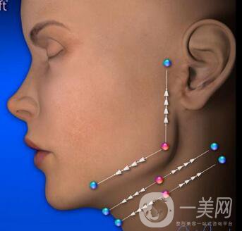 廣州電波拉皮除皺手術(shù)一般價(jià)錢