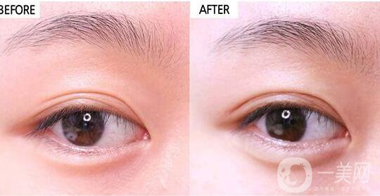 割雙眼皮,割雙眼皮價格