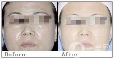 武漢電波拉皮的價錢是多少