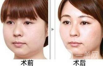 南京溶脂手術(shù)多少錢