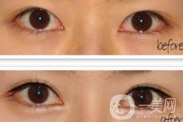 割雙眼皮加開(kāi)眼角*果怎么樣