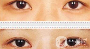 割雙眼皮加開(kāi)眼角*果怎么樣