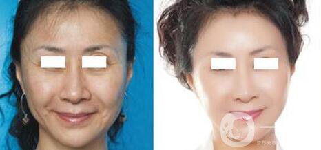 杭州電波拉皮術(shù)需要多少錢