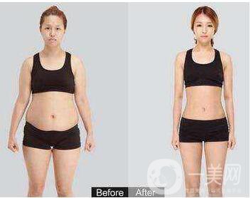 溶脂減肥手術,上海溶脂減肥手術價格,上海溶脂減肥手術注意事項