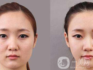 顴骨肉怎么消？怎么縮小顴骨？
