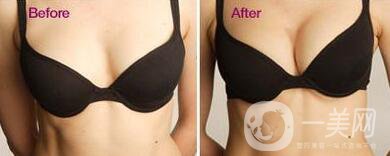 假體隆胸恢復(fù)期要多長(zhǎng)時(shí)間