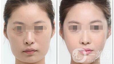 做過顴骨和下顎角手術(shù)后的感受