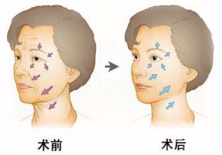 上海玻尿酸豐面頰價格是多少錢