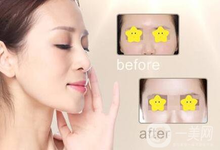 玻尿酸豐太陽(yáng)穴多少錢？