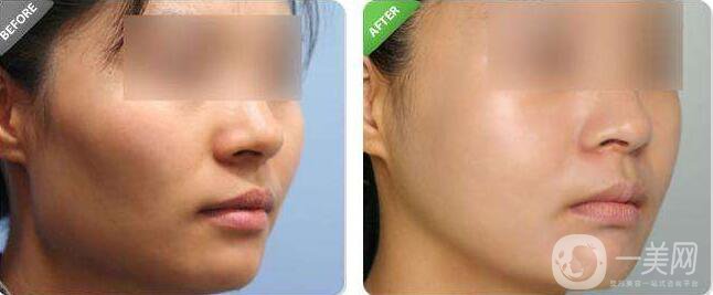 降低顴骨,降低顴骨方法,降低顴骨術(shù)后護理