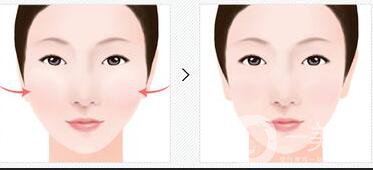 顴骨吸脂后會(huì)下垂嗎