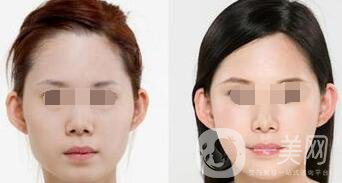 顴骨吸脂后會(huì)下垂嗎