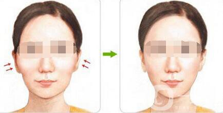 顴骨吸脂后會(huì)下垂嗎
