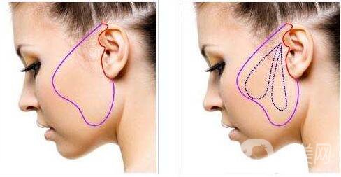 電波拉皮,電波拉皮*果 電波拉皮*果維持多久