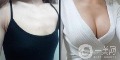 假體隆胸后感覺(jué)好嗎