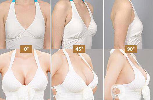 假體隆胸后感覺(jué)好嗎